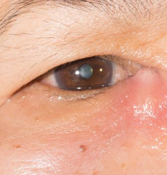 Oculoplastic and Lacrimal Surgery
